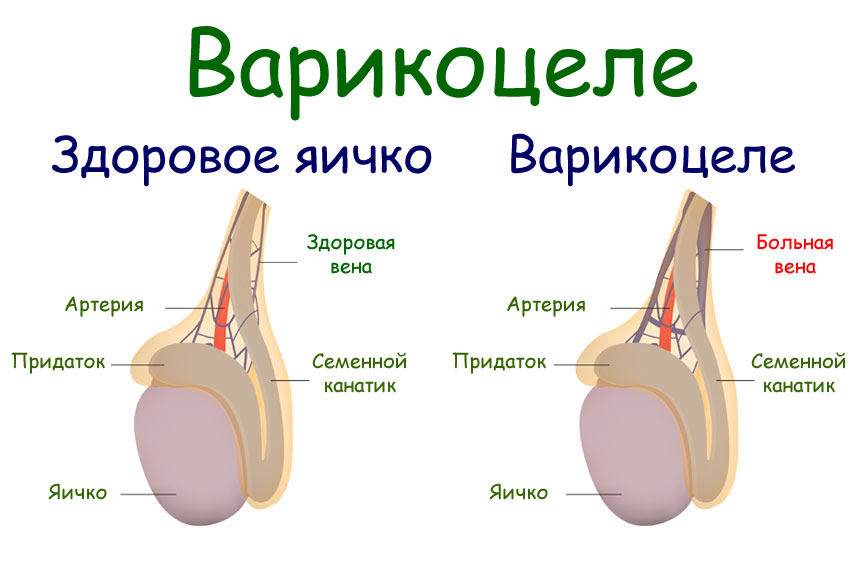 Полиорхизм яичек картинки