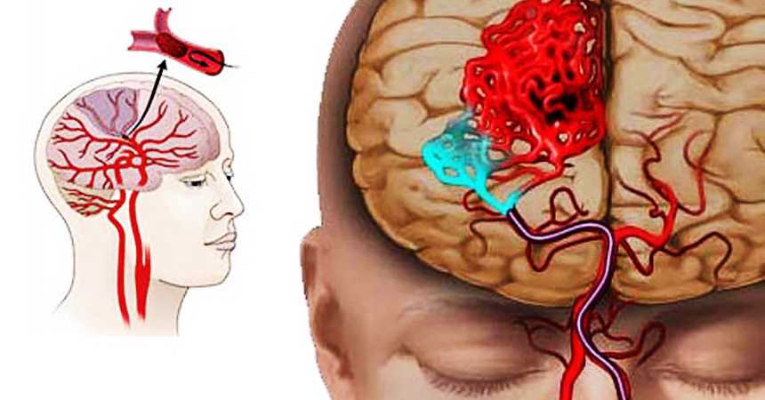 Bosh miya qon tomirlari aterosklerozi
