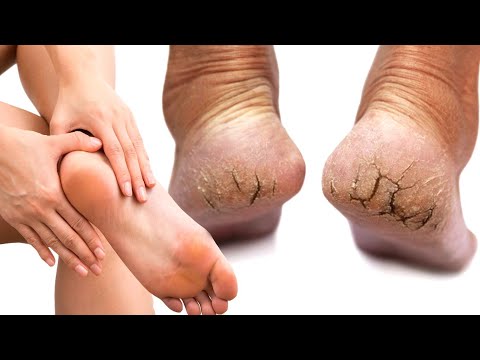 Oyoq yorilishini tabiiy usulda davolash