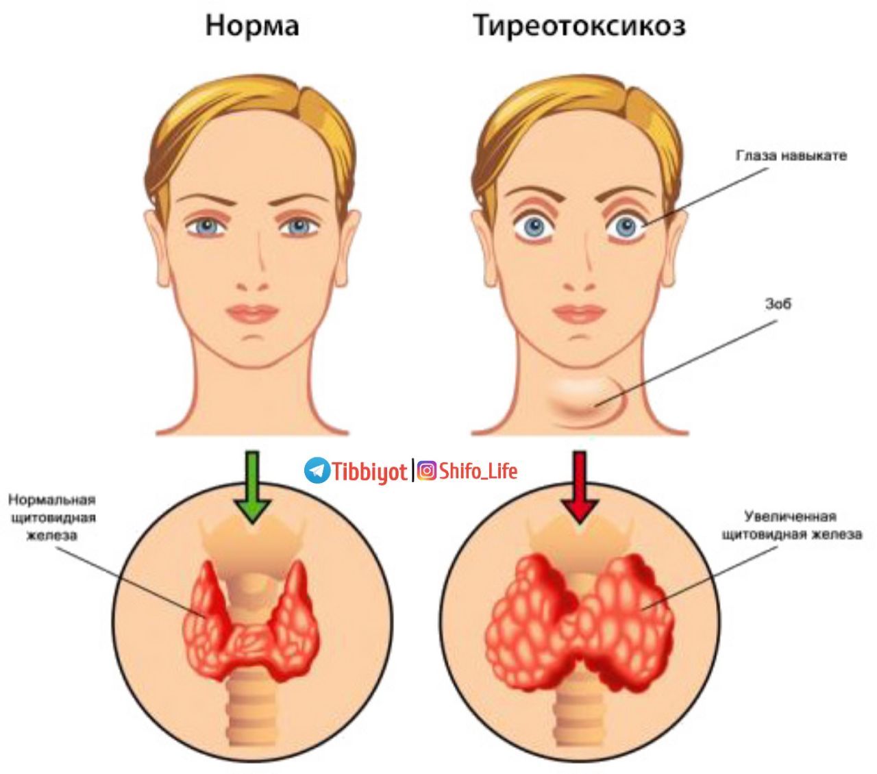 Гипотиреоз заболевание щитовидной