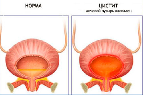 Sistit kasalligi havflimi…