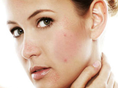 Yuzga allergiya toshishi. uning sabablari va turlari